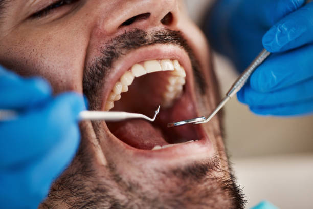 Dental Inlays and Onlays in Hinsdale, IL